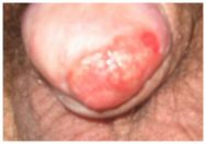penile cancer pic-2